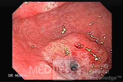 Gastric Ulcerated Adenocarcinoma of the Pre-pyloric Antrum (3 of 28)