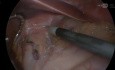 Redo Hiatal Hernia