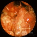 Wegener's Granulomatosis Nasopharynx