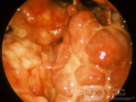 Wegener's Granulomatosis Nasopharynx