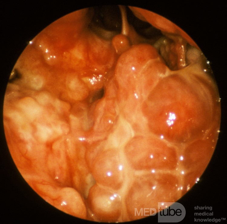 Wegener's Granulomatosis Nasopharynx