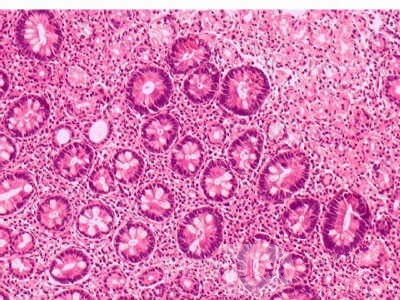 Intestinal Metaplasia of the Pre-Piloric Antrum. Chronic gastritis with intestinal metaplasia (3 of 3)