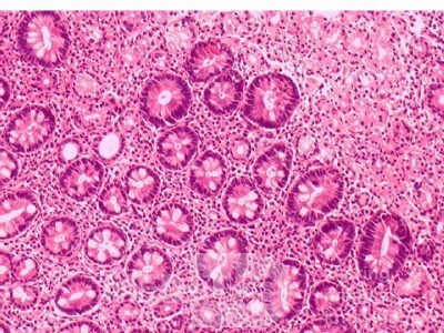 Intestinal Metaplasia of the Pre-Piloric Antrum. Chronic gastritis with intestinal metaplasia (3 of 3)