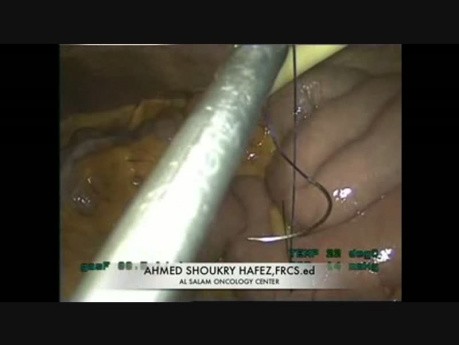 Laparoscopic Feeding Jejunostomy