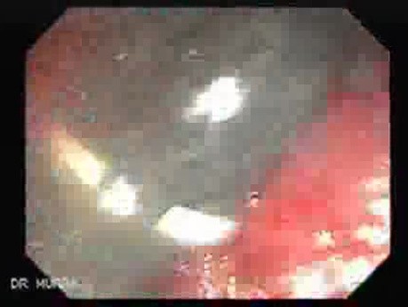 Tubulo - Villous Rectal Adenoma - Endoscopy (4 of 35)