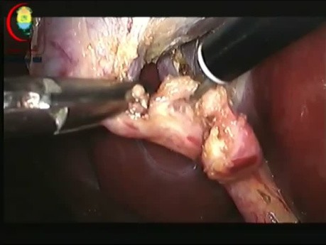 Madany Triangle; a New Era of Laparoscopic Cholecystectomy