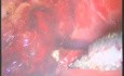 Laparoscopic Cholecystectomy - Coagulation Of Bleeding Vessels