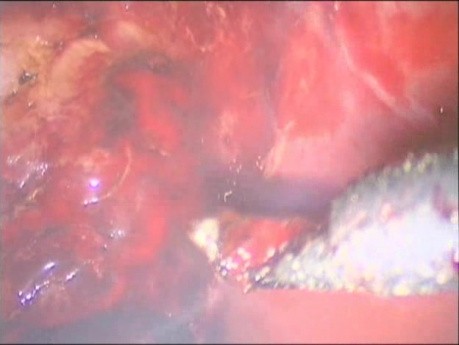 Laparoscopic Cholecystectomy - Coagulation Of Bleeding Vessels