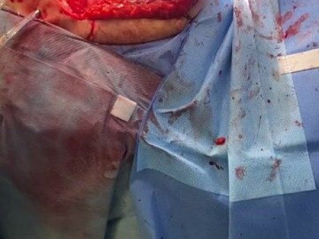 Bilateral Lung Transplantation in Patient with ILD Closure of Chest and Drain Insertion