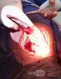 Meningocele in an 18-year-old patient