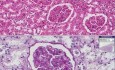 Membranous glomerulonephritis - Histopathology - Kidney