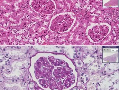 Membranous glomerulonephritis - Histopathology - Kidney