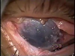 Symblephron - surgery with use of Fugo Plasma Blade
