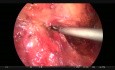 Lap Anterior Resection with Hernia
