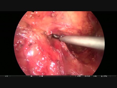 Lap Anterior Resection with Hernia