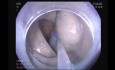 Large Sigmoid Mass Excision