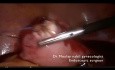 Challenging laparoscopic myomectomy