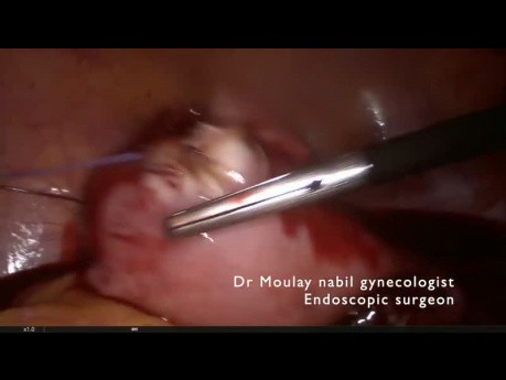 Challenging laparoscopic myomectomy