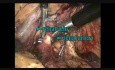 Laparoscopic Left Nephrectomy