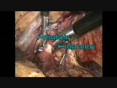 Laparoscopic Left Nephrectomy