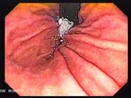 High Resolution Video Endoscopy with Zoom - Gastric Body