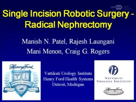 Single Incision Robotic Surgery For Radical Nephrectomy