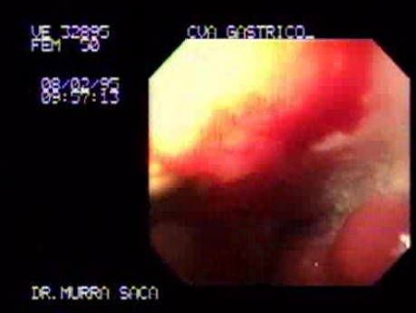 Gastric Adenocarcinoma - Obstruction 5
