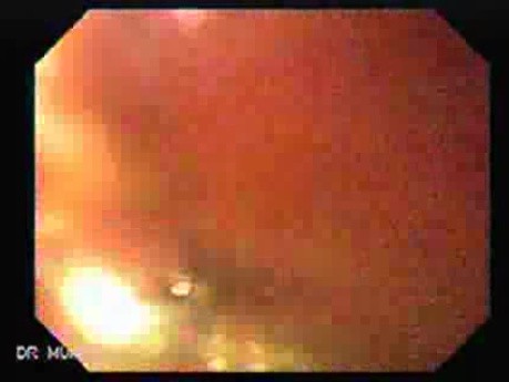 Gastric Cancer - Endoscopy (1 of 15)