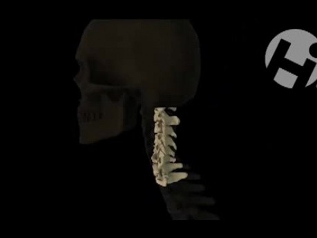 Fractured C5 Vertebral Body