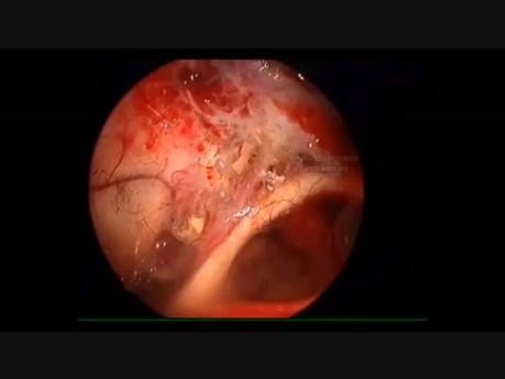 Large Ruptured Dermoid Cyst
