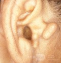 Accessory Auricle