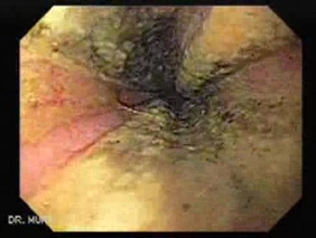 The Black Esophagus - Assessment of Esophageal Mucosa, Part 1
