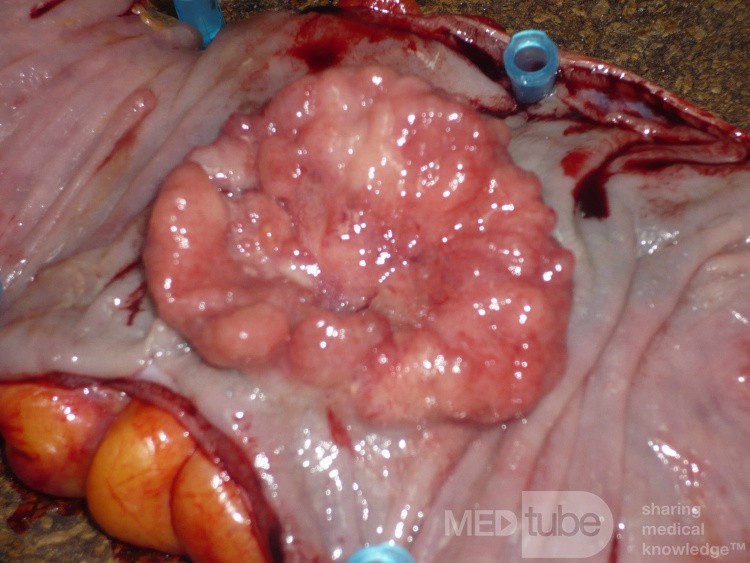 Colon Adenocarcinoma, Villous Adenocarcinoma (12 of 12)