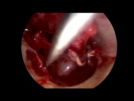 Endoscopic Type 3 Tympanoplasty for Active Phase Chronic Mucosal Otitis Media