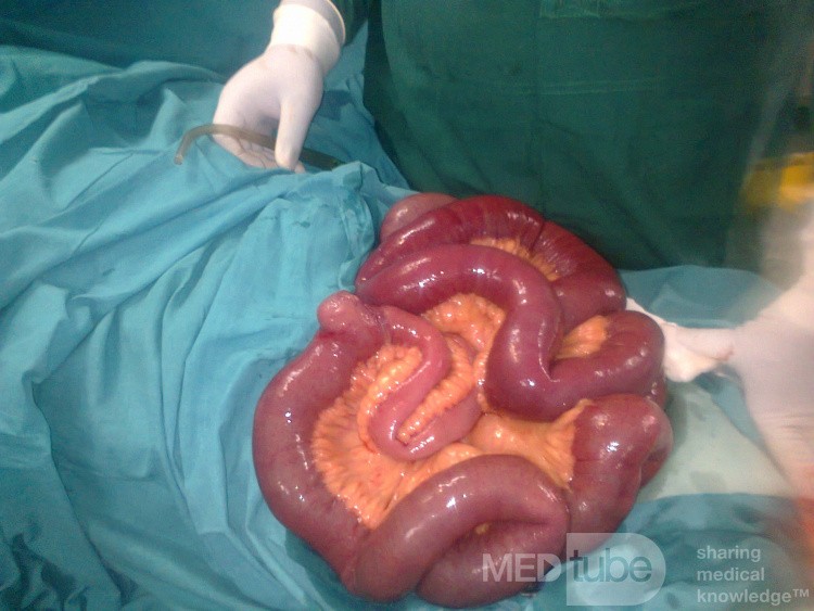 Meckel's Diverticulum