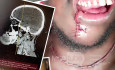 Adult fibrosarcoma in the anterior region of the mandible