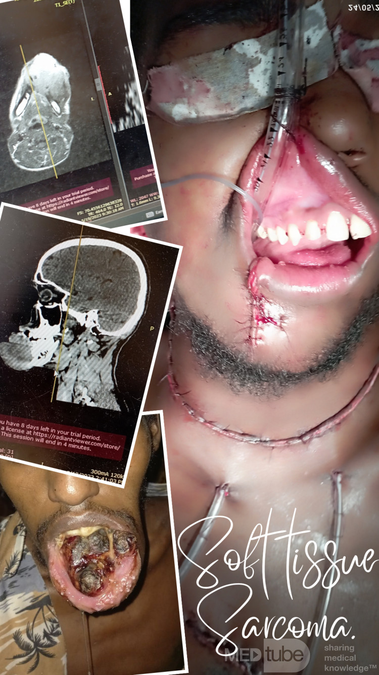 Adult fibrosarcoma in the anterior region of the mandible