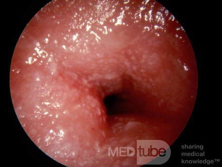 Severe Otitis Externa due to Contact Dermatitis