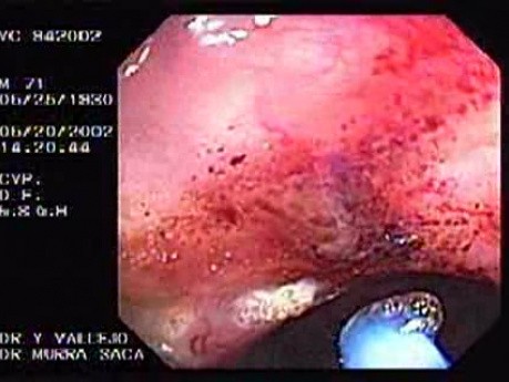 Radiation Proctosigmoiditis (7 of 14)
