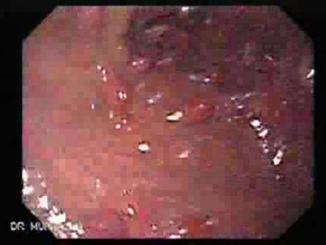 Gastric Polyposis - Endoscopy (5 of 11)
