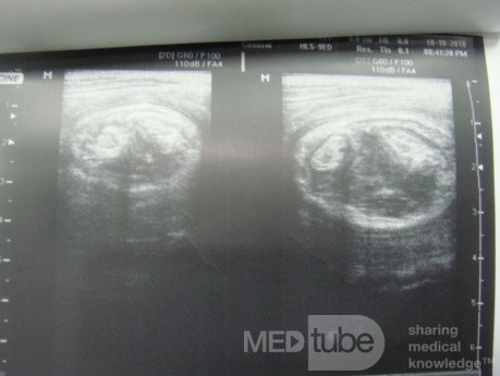 Intussusception on US