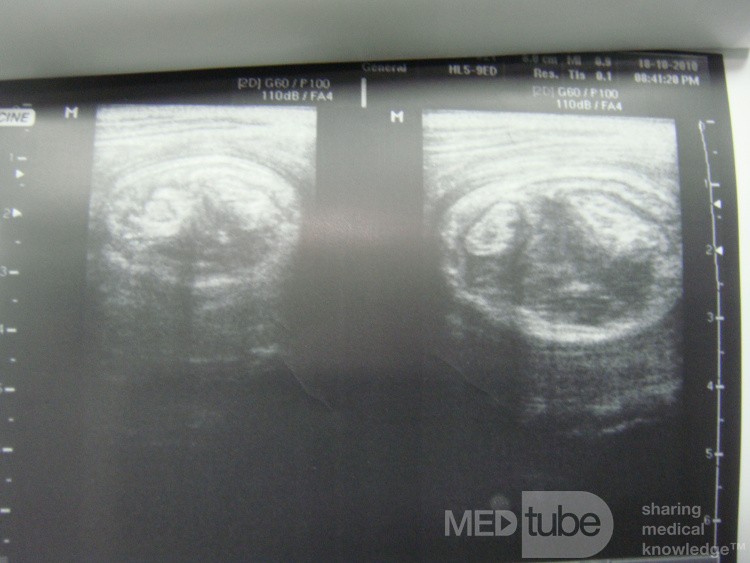 Intussusception on US