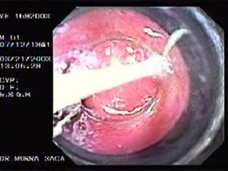 Banding of Esophageal Varices - Suction