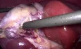 Bloodless Laparoscopic Cholecystectomy