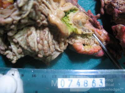 Synchronous Cancers, Familial Adenomatous Polyposis (31 of 36)