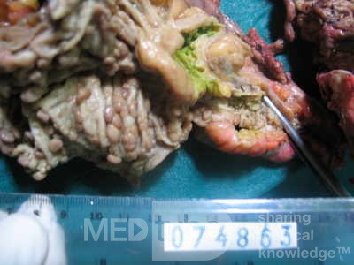 Synchronous Cancers, Familial Adenomatous Polyposis (31 of 36)