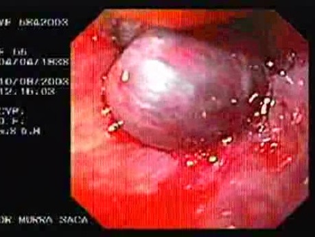 Banding of Esophageal Varices - Scars and Ligated Varices