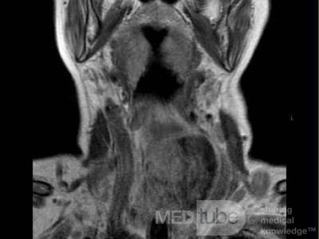 Esophageal Squamous Cell Carcinoma of the the upper third of the Esophagus that invades the subglotic (8 of 8)