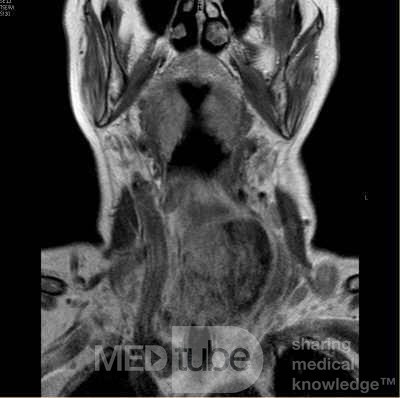 Esophageal Squamous Cell Carcinoma of the the upper third of the Esophagus that invades the subglotic (8 of 8)