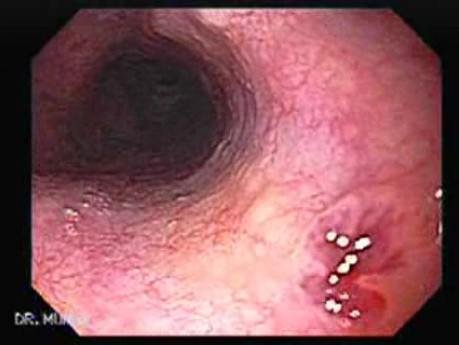 Endoscopic Assessment of Esophageal Papilloma, Part 1
